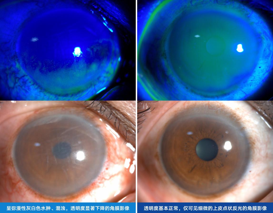 蛇毒喷眼险失明！泉州爱尔眼科温馨科普眼外